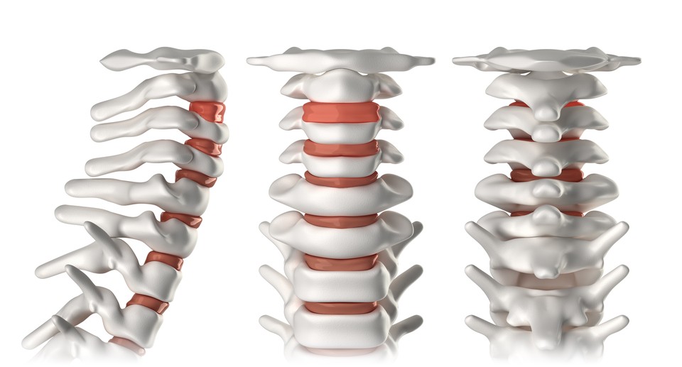 Cervical Artificial Discs
