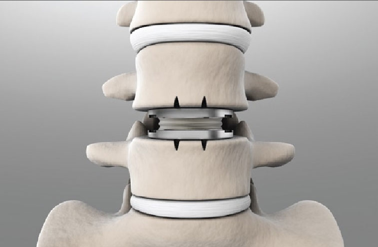 Lumbar Artificial Discs