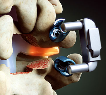 Transforaminal Lumbar Interbody Fusion