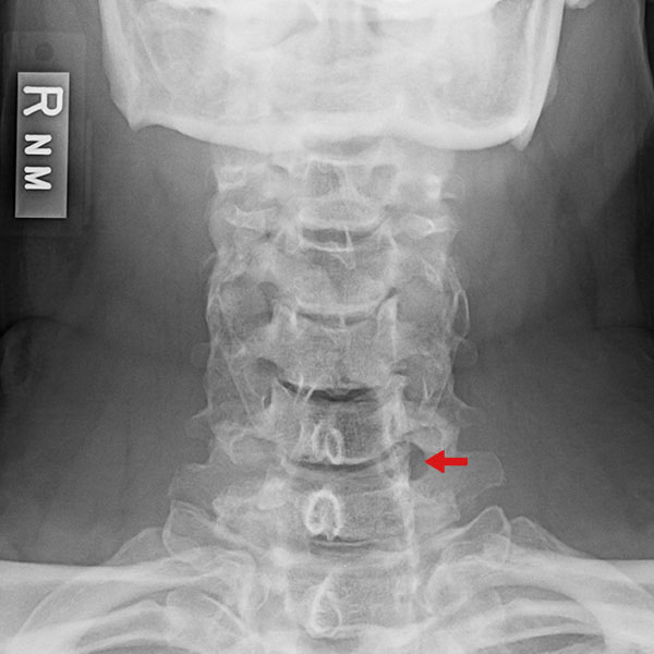 Posterior Cervical Foraminotomy