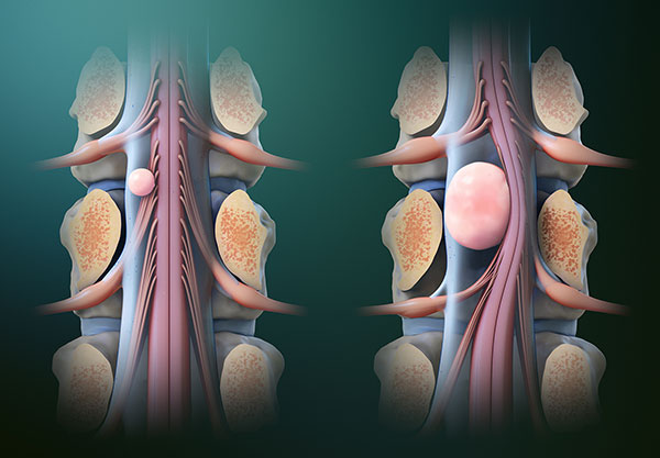 Spinal Cord Tumor Removal